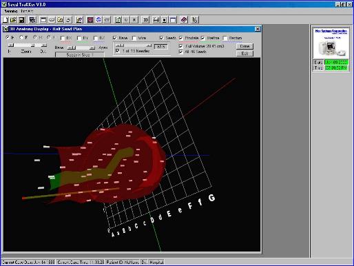 Full interactive 3D display of anatomical features and radioactive seeds with customizable electronic template.